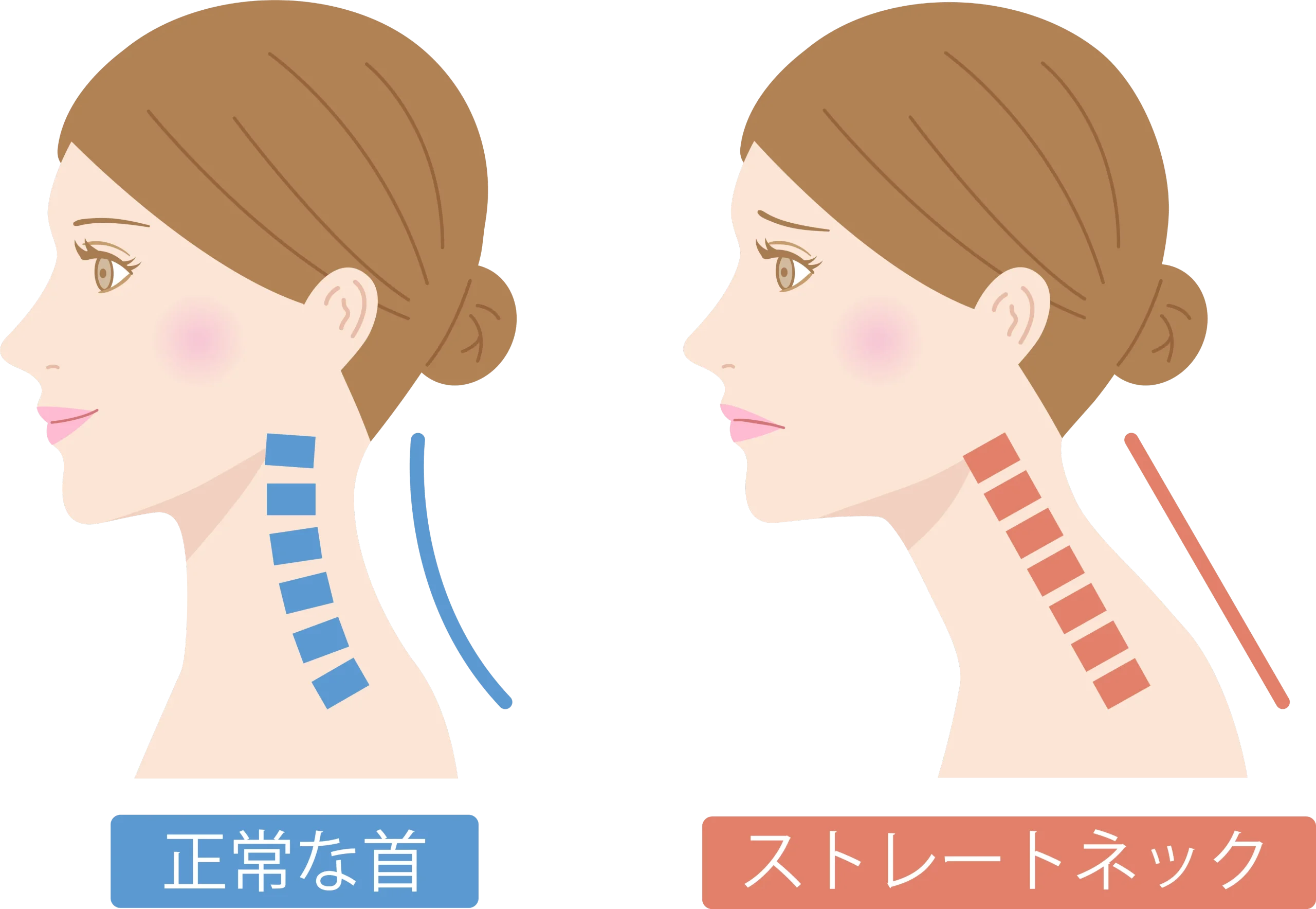 正常な首のカーブとストレートネックの比較図