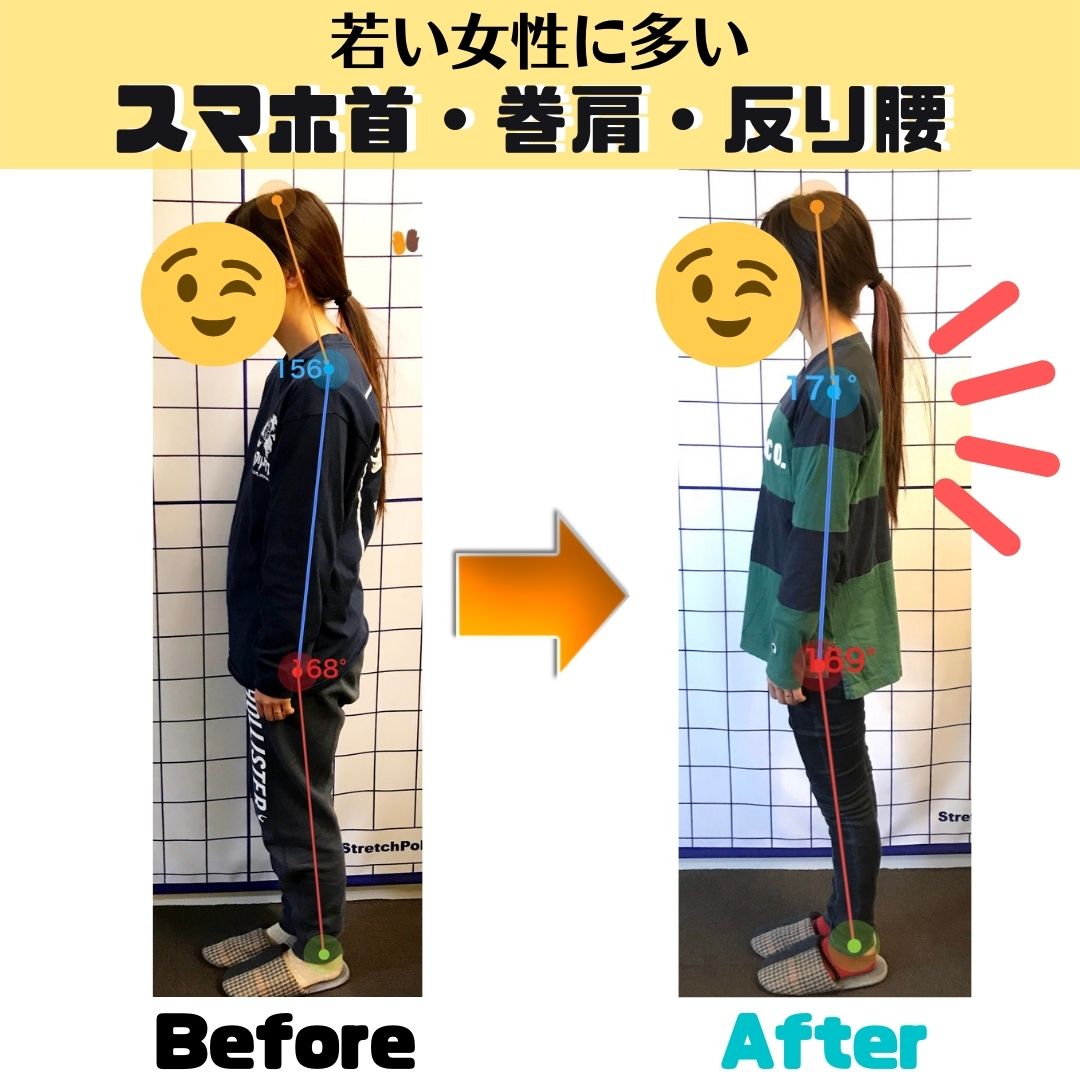 20代女性 巻き肩・肩こり改善